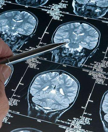 Araştırma: Alzheimer düşünüldüğünden daha erken başlayabilir