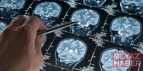 Araştırma: Alzheimer düşünüldüğünden daha erken başlayabilir