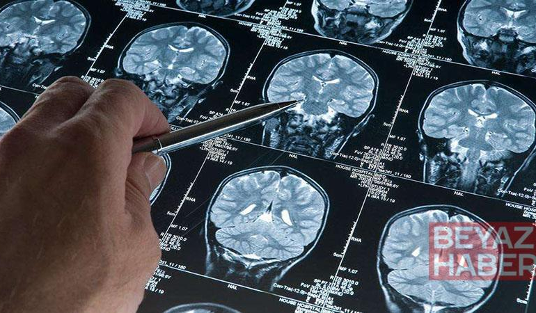 Araştırma: Alzheimer düşünüldüğünden daha erken başlayabilir