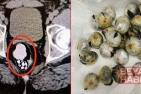 Midesinde uyuşturucu madde bulunan şüpheli, tutuklandı