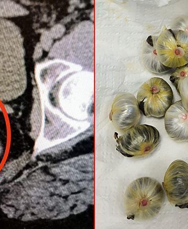 Midesinde uyuşturucu madde bulunan şüpheli, tutuklandı