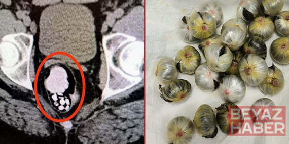 Midesinde uyuşturucu madde bulunan şüpheli, tutuklandı