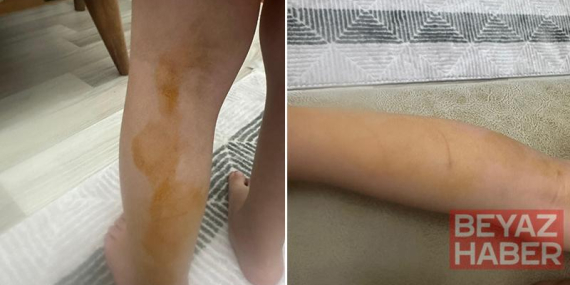 Sokak köpeğinin saldırısına uğrayan Erva yaralandı