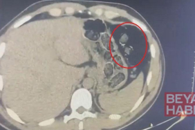 Midelerinden uyuşturucu taşıyan 2 şüpheli tutuklandı